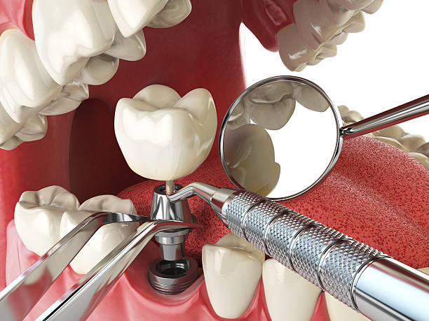 Best Emergency Tooth Extraction in Terryville, NY